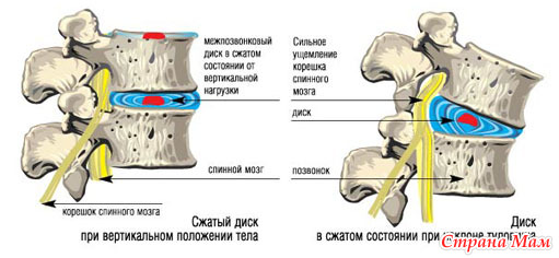 Боли в паху при синдроме грушевидной мышцы
