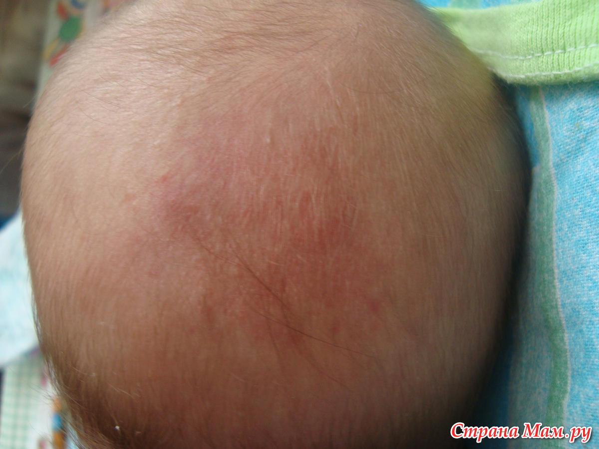 Спина бифида у детей фото