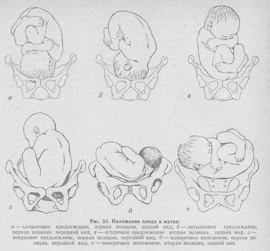Положение плода продольное головное предлежание это как фото