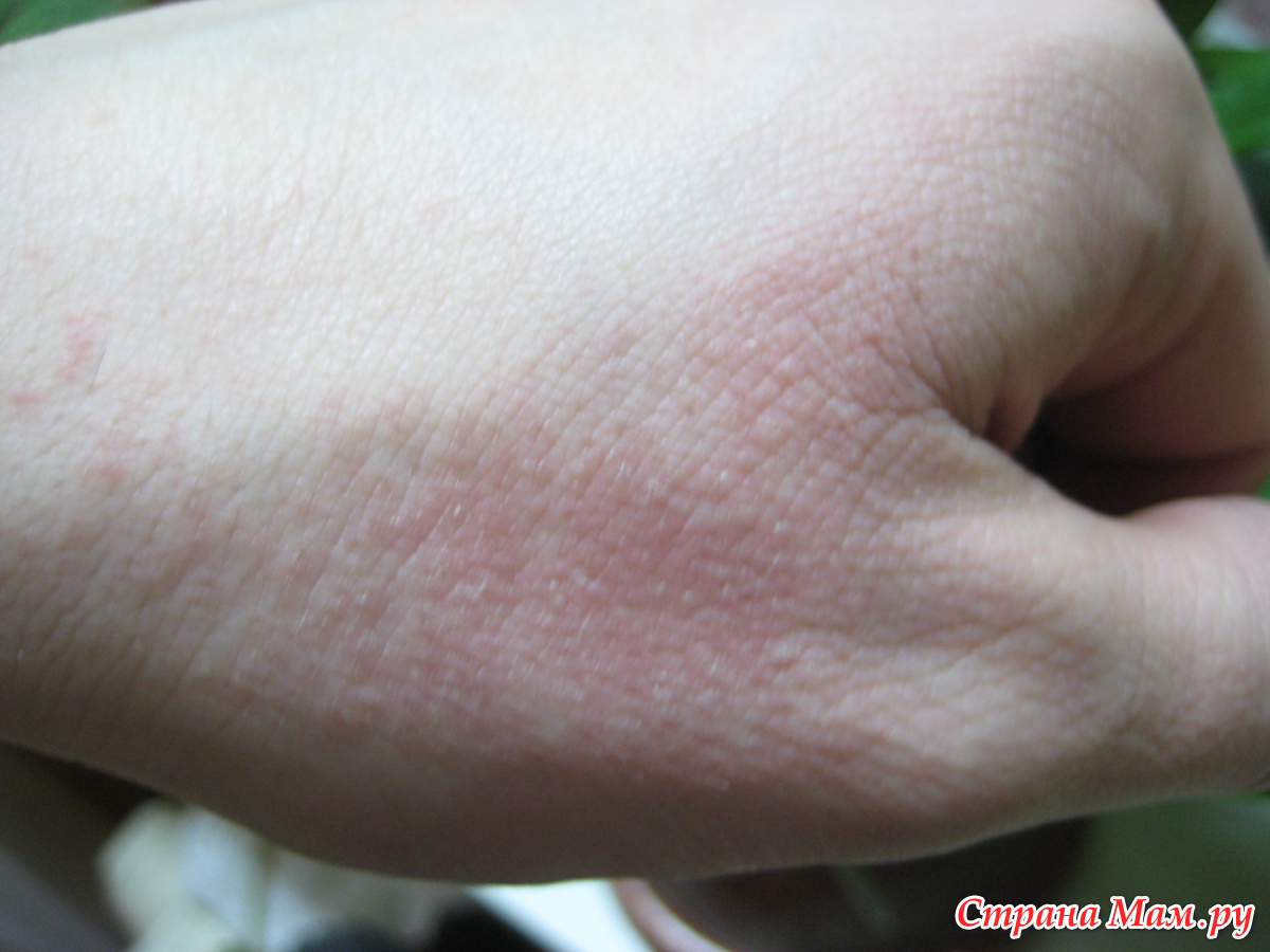 Летнее раздражение кожи – лечение в Кривом Роге воспалений и сыпи