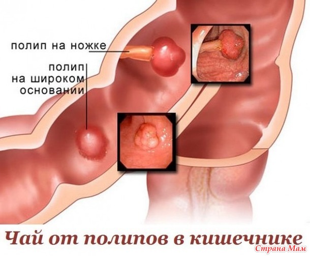 чай от полипов в кишечнике