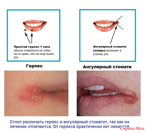 быстро вылечить заеды в уголках рта или на губах