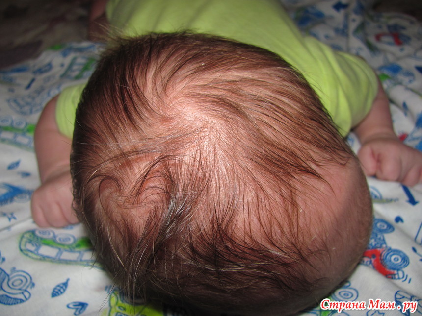 Два затылка. Две макушки на голове. Родимое пятно на голове у ребенка. Красные пятна на голове у новорожденного.