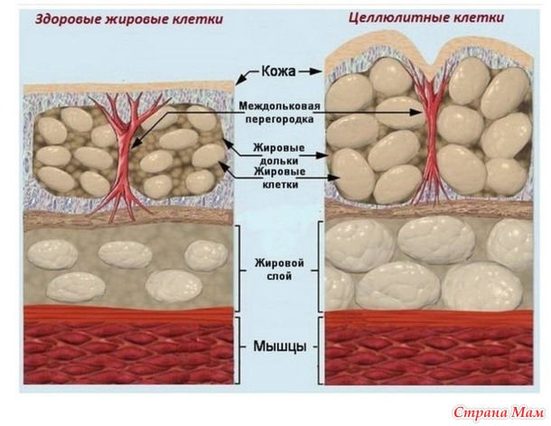 Целлюлит
