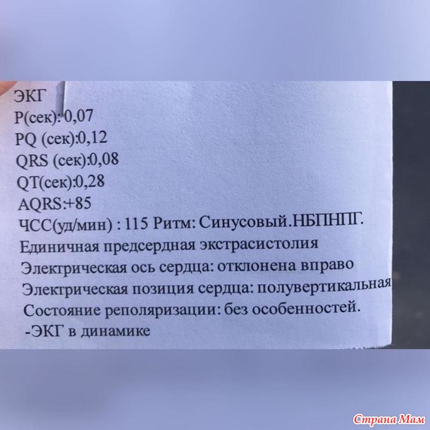 Предсердная экстрасистолия