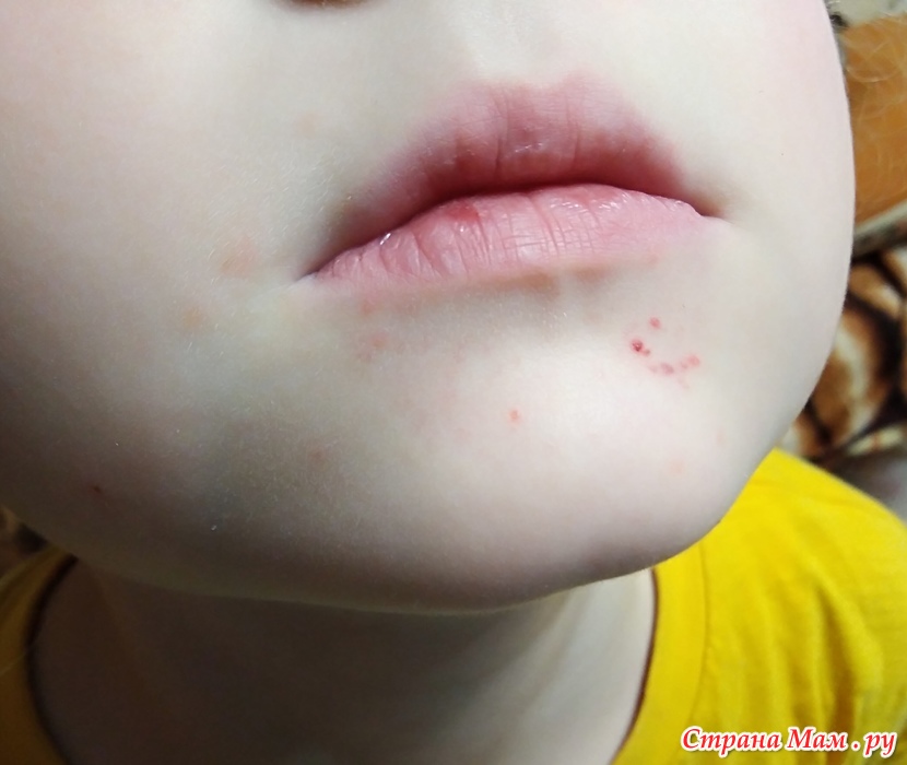 Синие губы и синяки. Как проявляются опасные заболевания у детей? | Аргументы и Факты