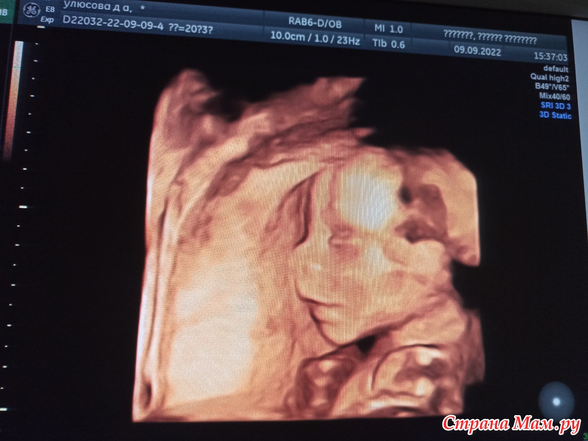 Сходили на второй скрининг - Страна Мам